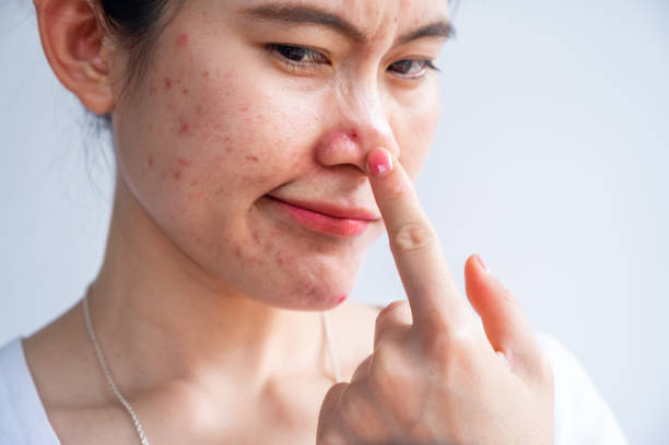 Causes of Acne Breakouts