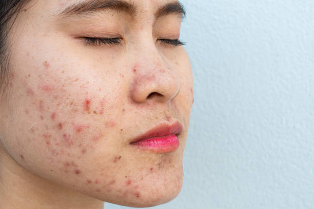Causes of Acne Breakouts