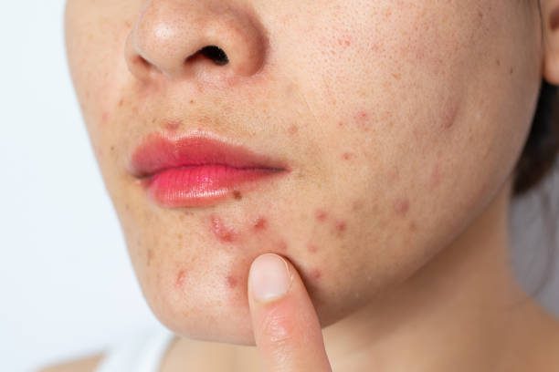 What Causes Acne?