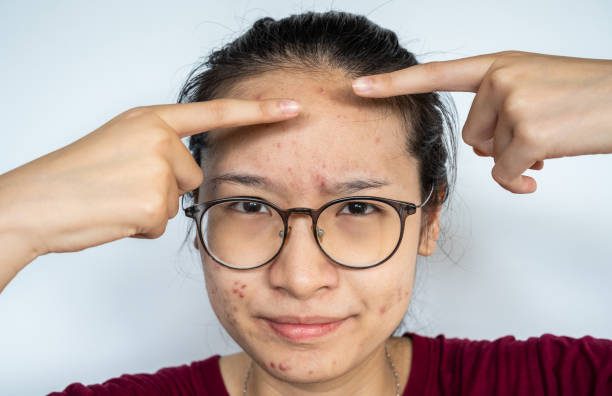 Causes of Worsening Acne