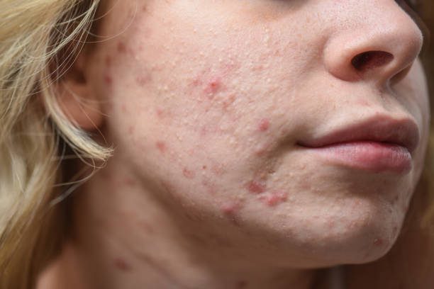 Causes of Acne Vulgaris