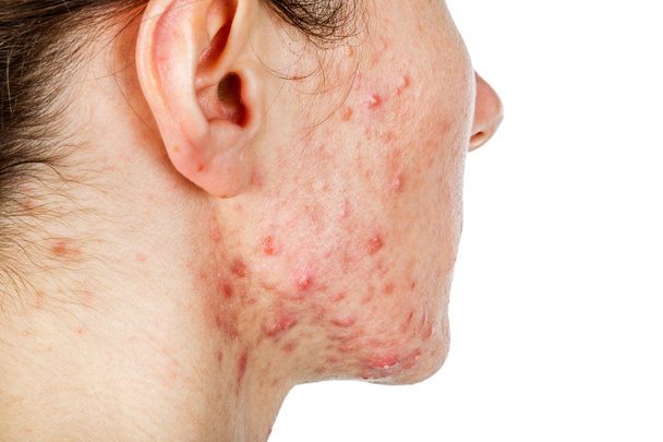 Causes of Acne Scars