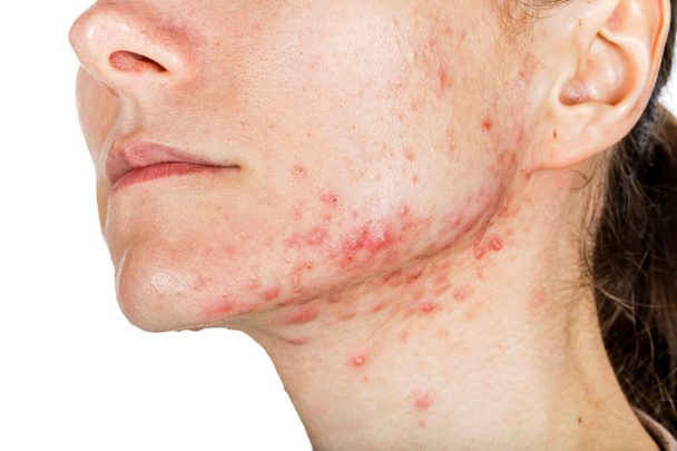 Causes of Acne Scars